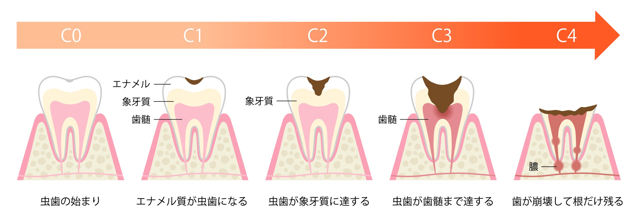 むし歯の進行段階 C0からC4までの図。C0 むし歯の始まり、C1 エナメル質がむし歯になる、C2 むし歯が象牙質に達する、C3 むし歯が歯髄まで達する、C4 歯が崩壊して根だけ残る