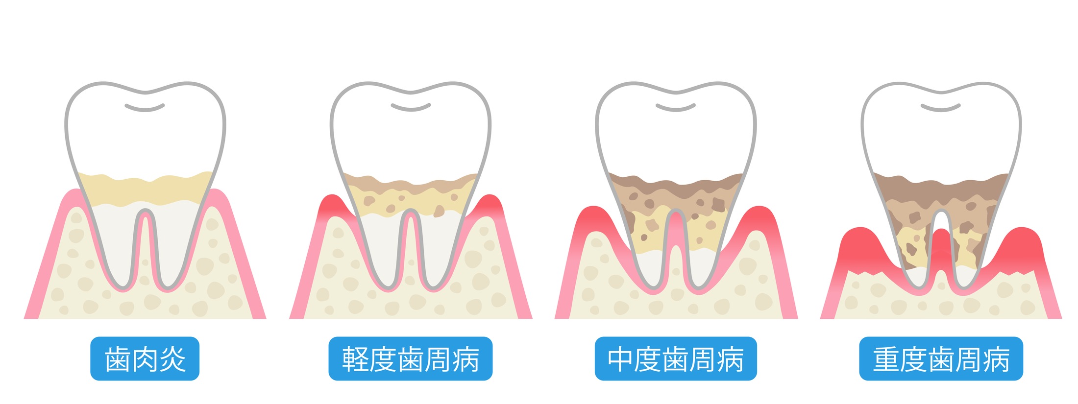 歯周病の進行と症状の図